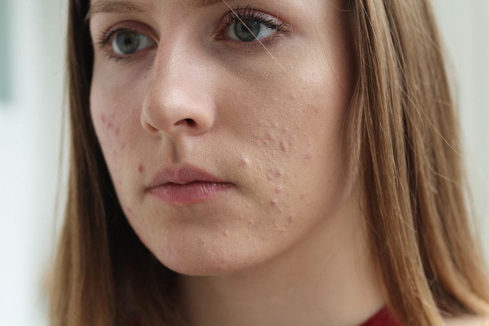 More than half of those with a skin condition feel ‘judged’