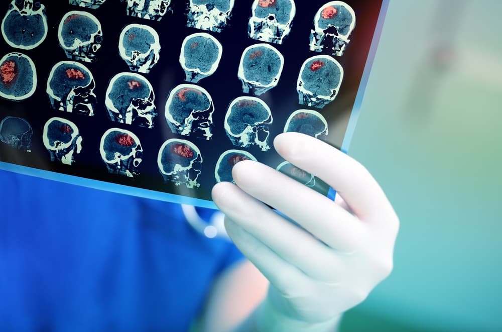 I Had a Stroke at 49 that Nearly Killed Me
