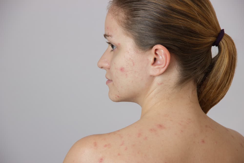 I’m 27 But Still Get Acne! How Can I Combat My Spots?