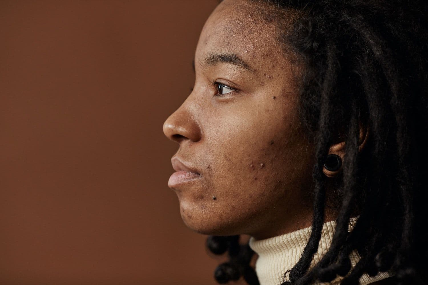 Mental health support recommended for those struggling with acne
